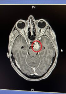 Meningioma tumor circled on MRI scan
