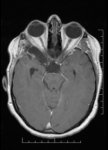 diaphragma sellae meningioma